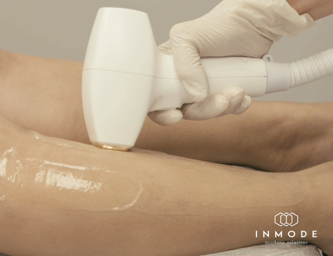 Epilation indolore avec le laser Diolaze XL de InMode